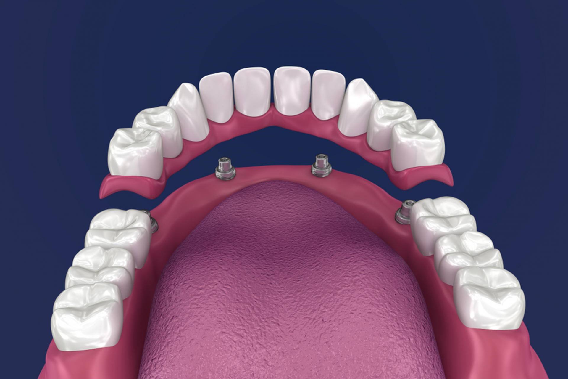 Implant supported dentures in Red Deer
