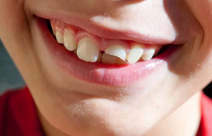 Worn or Chipped Teeth Treatment Near You