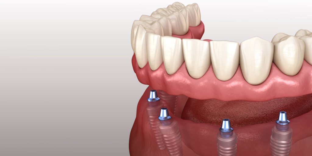implant supported dentures in red deer