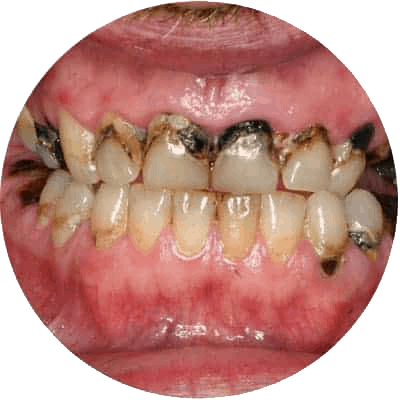Dental Cavity Treatment in Red Deer