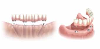 fixed_dentures_dental_implats