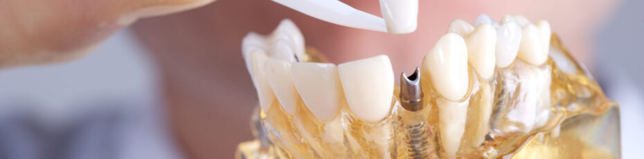 10 Things You Need to Know About Dental Implants in Red Deer