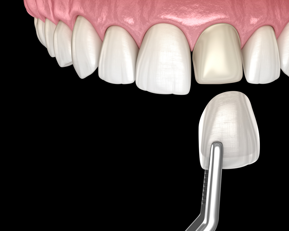 who is a good candidate for dental veneers